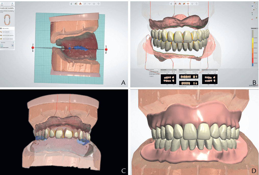 dental dentures